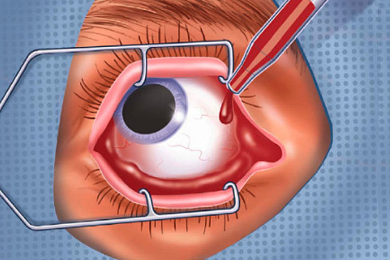 Die Bindehaut des Auges wird erneut gereinigt und desinfiziert.
