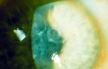 Wirbelartige Trübungen bei angeborener Hornhauterkrankung (Basalmembran-Dystrophie), Sehschärfe 10 %
