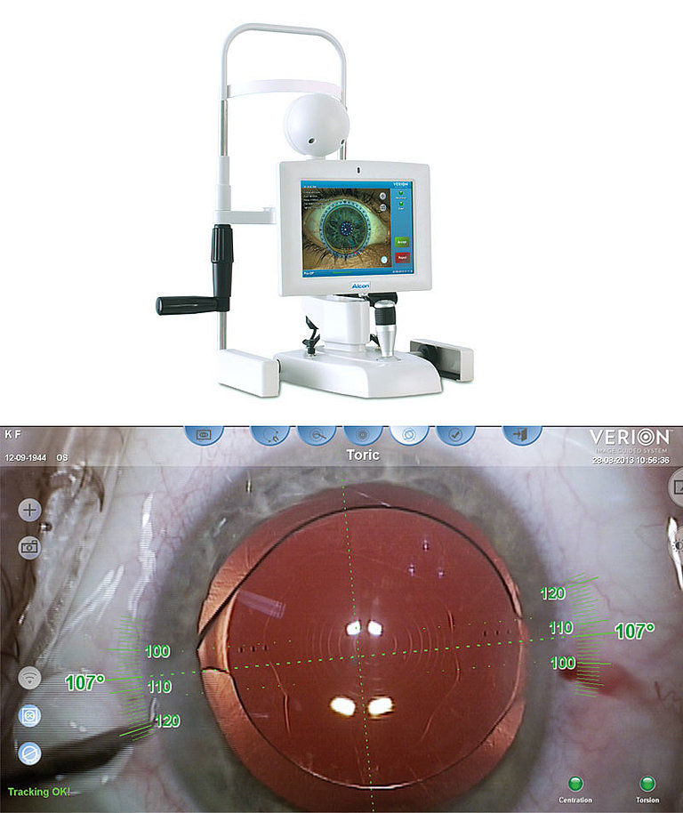 VERION™ Image Guided System (Alcon)