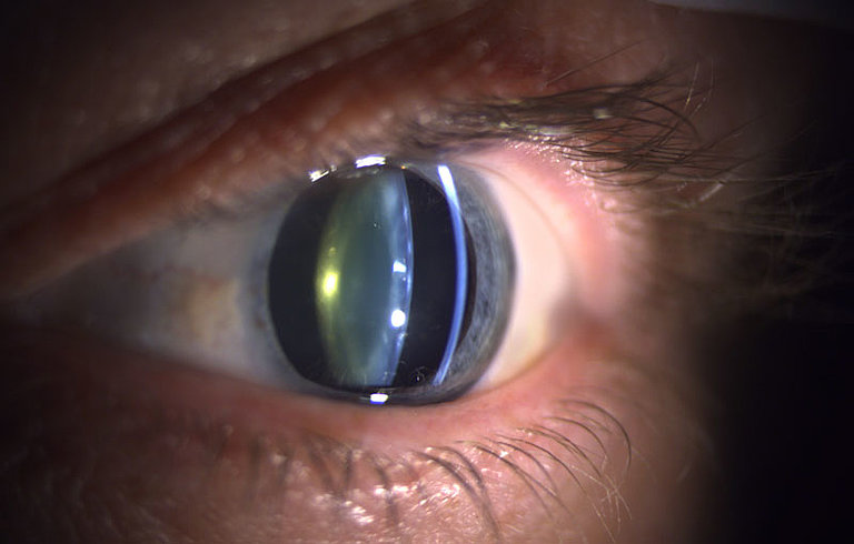 Augenlinse