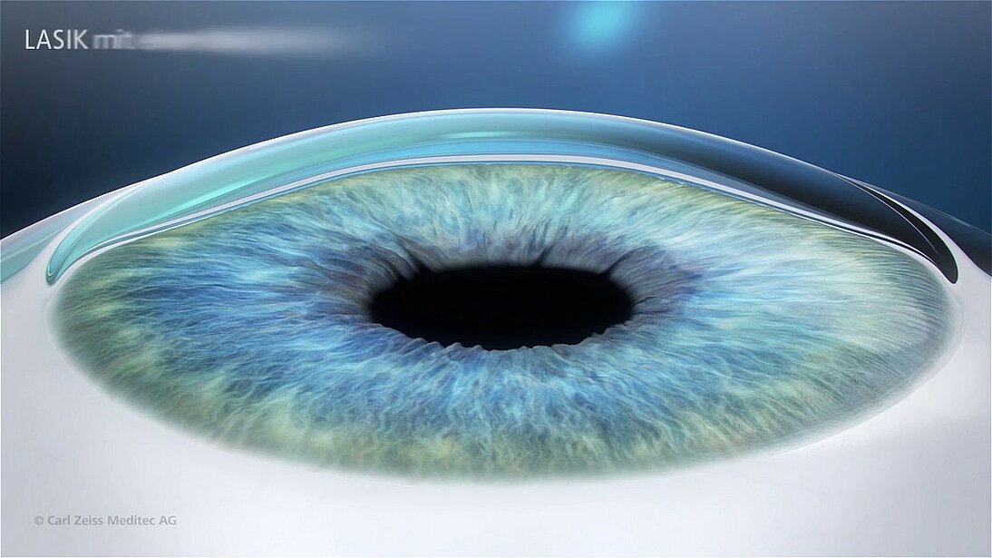 Augenlasern - Lasik mit einem Excimer-Laser