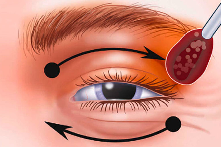 Reinigung und Desinfektion des Auges