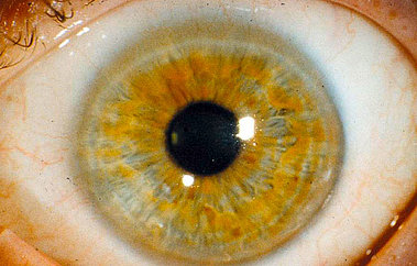 Dasselbe Auge einen Monat nach durchgeführter PTK, Sehschärfe 80 %