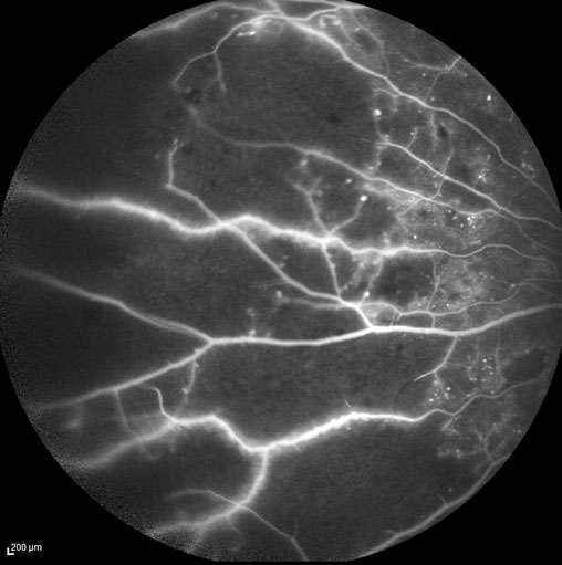 Die dunklen Bereiche in dieser Fluoreszenzangiografie-Aufnahme sind nicht ausreichend durchblutet und sollten mit dem Netzhaut-Argonlaser behandelt werden.